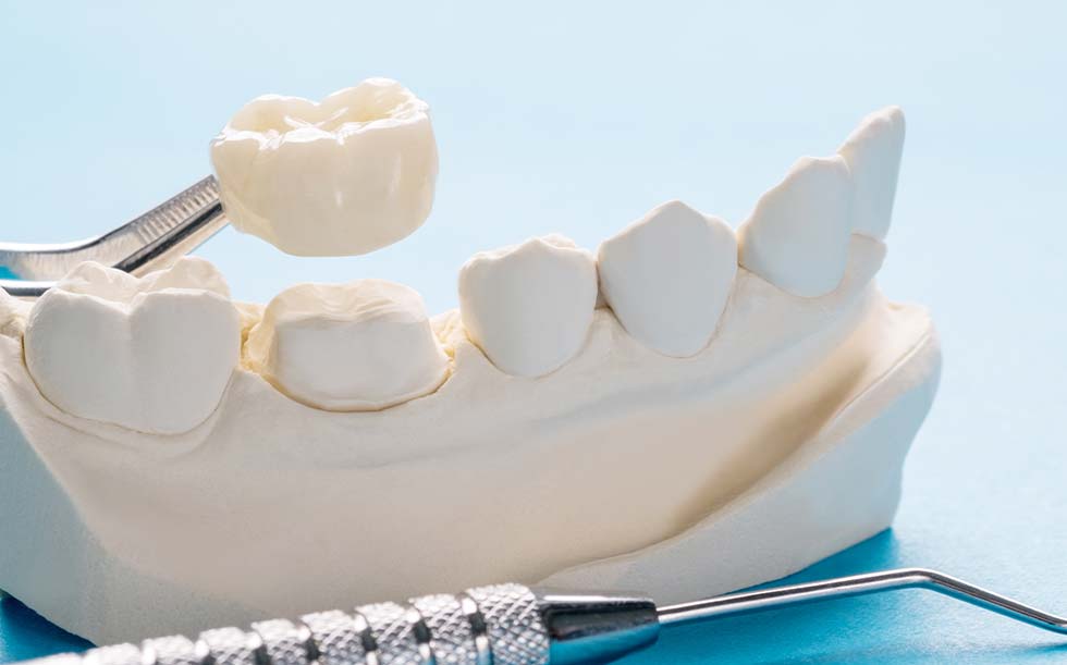Close up of a tooth crown | Family Dentistry in Texarkana, TX