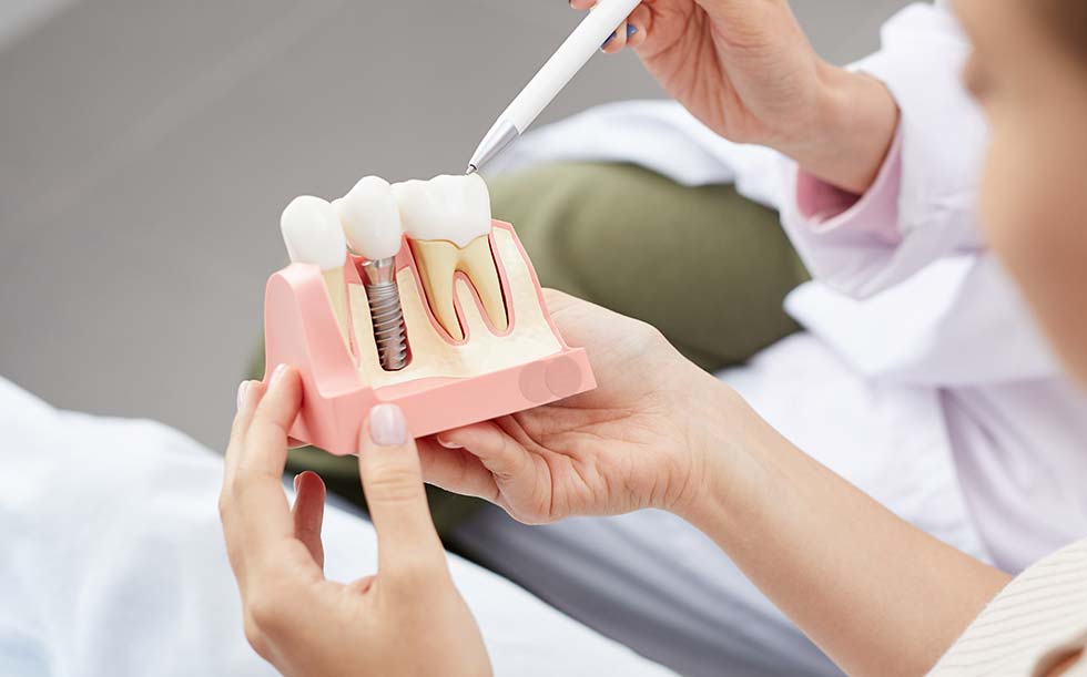 Dental implant model | Family Dentistry in Texarkana, TX