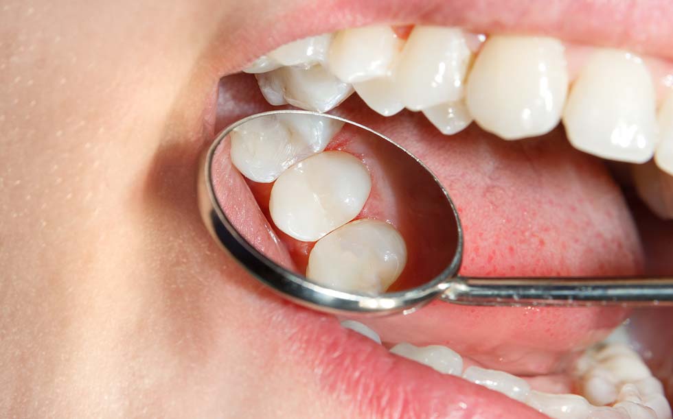 Tooth colored filling | Family Dentistry in Texarkana, TX